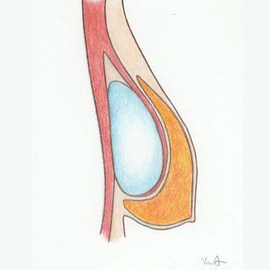 Diagram of breast implants