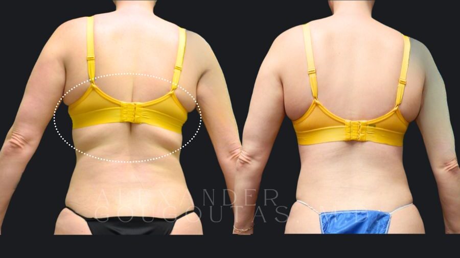 Actual Patient Breast Surgery Results 3