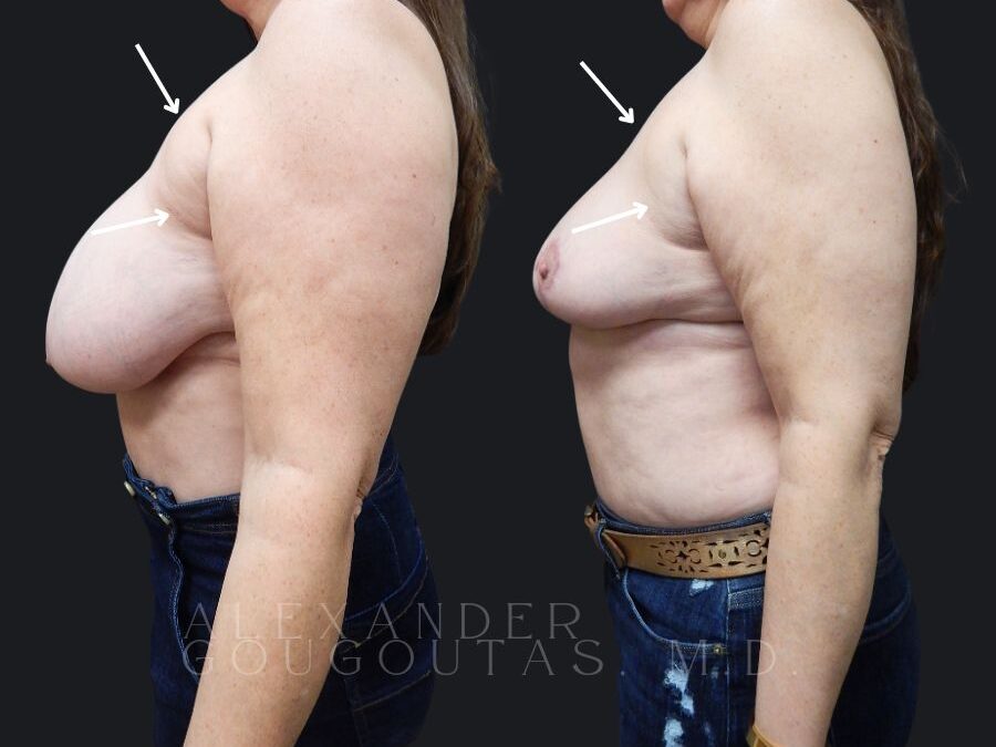 Actual Patient Breast Surgery Results