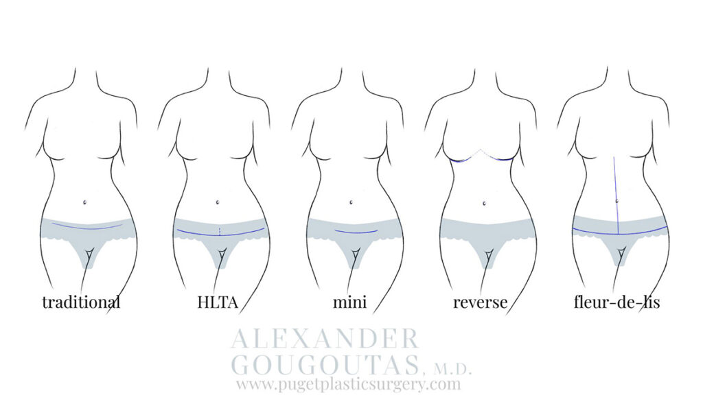 Graphic of mini vs. traditional vs. fleur-de-lis vs. reverse and belly button incisions
