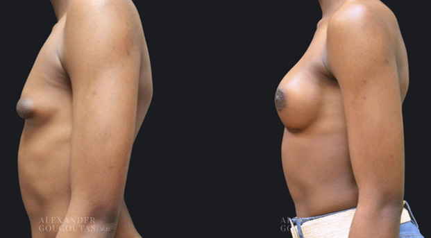 Gender Affirming Breast Augmentation Patient 02