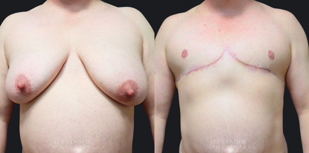 Masculinizing Chest Contouring Patient 01