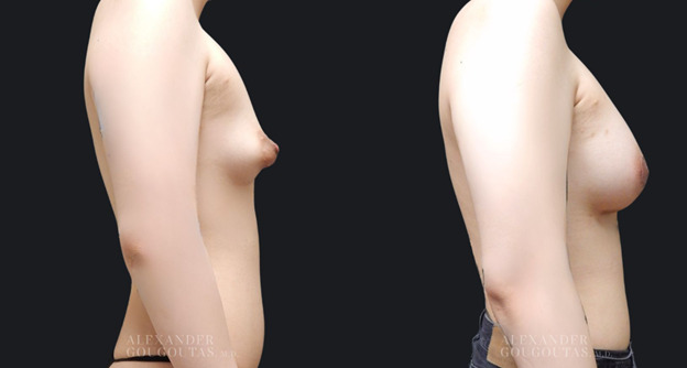 Gender Affirming Breast Augmentation Patient 04