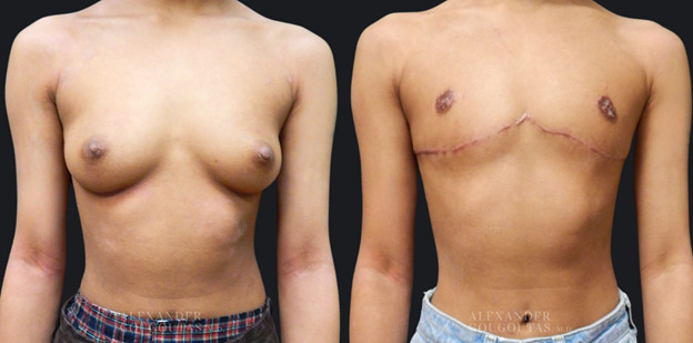 Masculinizing Chest Contouring Patient 03