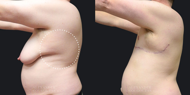 Masculinizing Chest Contouring Patient 02