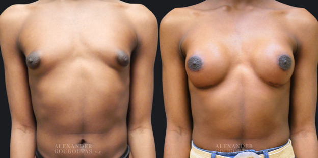 Gender Affirming Breast Augmentation Patient 01