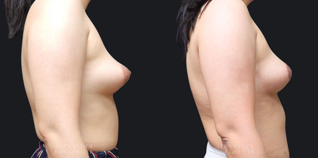 Gender Affirming Breast Augmentation Patient 06