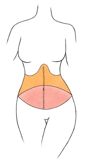 Alexander Gougoutas, M.D. - What Is a High Lateral Tension Abdominoplasty (HLTA)?