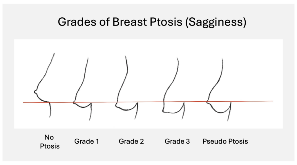 Breast sagginess diagram