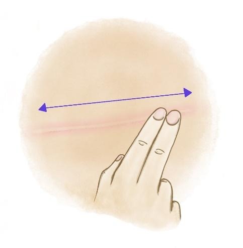 Alexander Gougoutas, M.D. - Scar Care Following Plastic Surgery