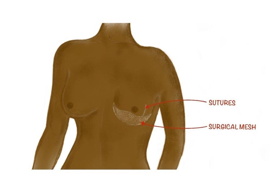 Diagram of an internal bra