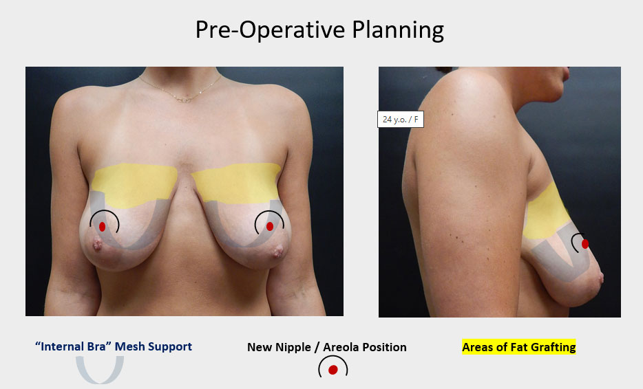 Pre-Operative Planning
