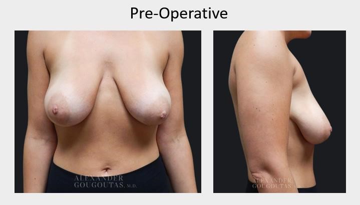 Alexander Gougoutas, M.D. - Case Example: Breast Lift With Mesh