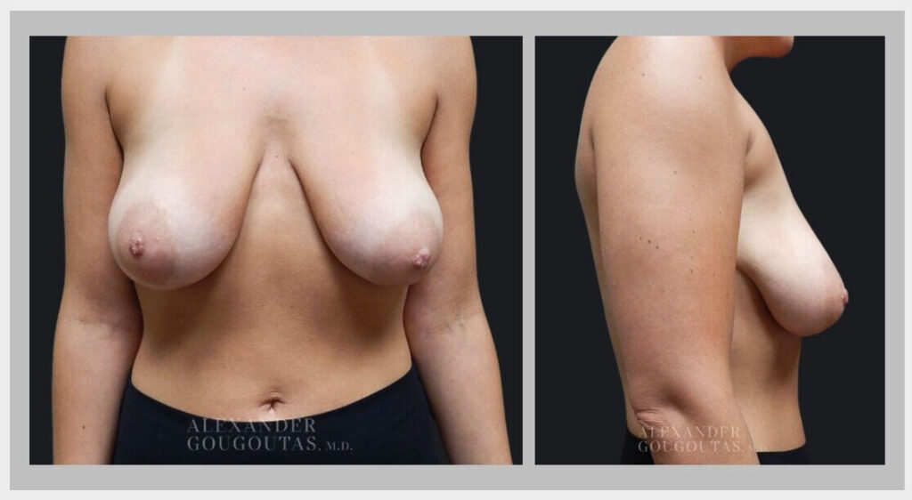 Alexander Gougoutas, M.D. - Breast Lift vs. Breast Augmentation: Which Is Right for You?