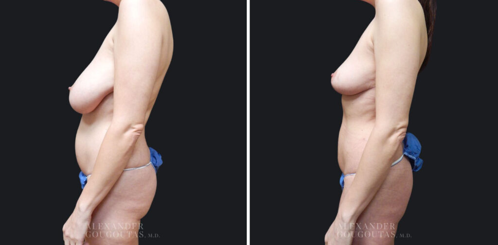 Liposuction Patient Results