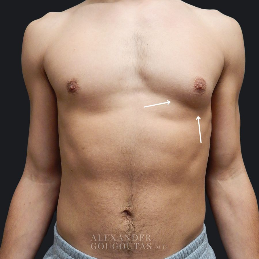 Case--7692 | Before Breast Reduction for Men (Gynecomastia) 1