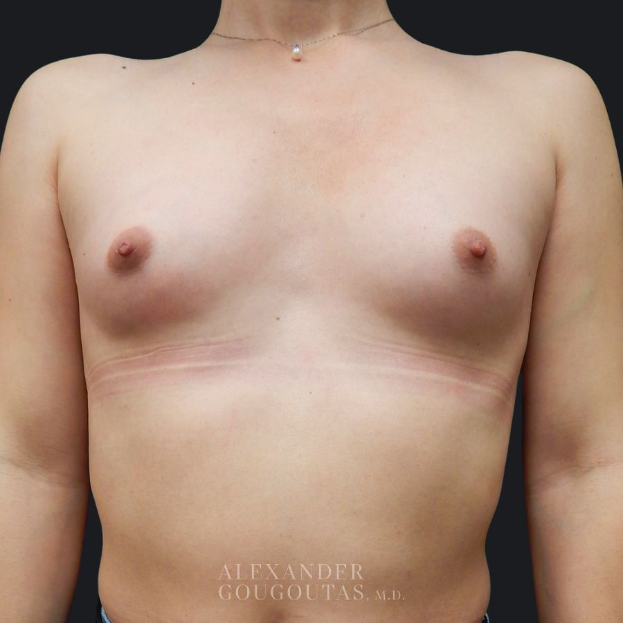 Case--1811 | Before Breast Augmentation 1