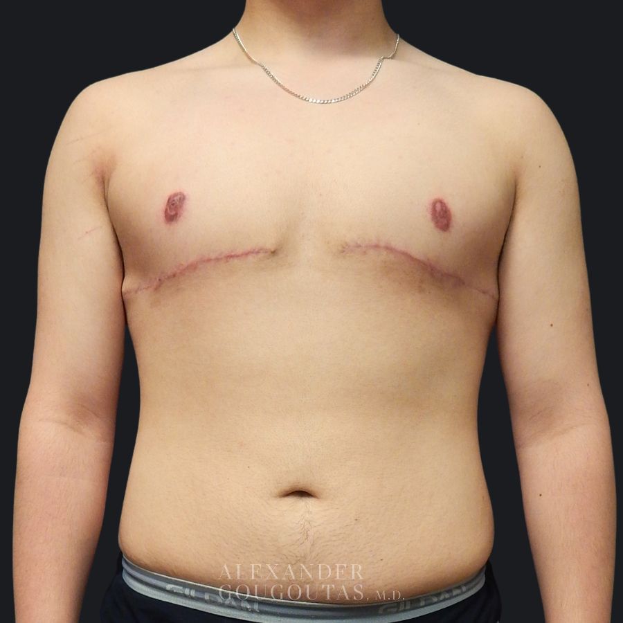 Case--6799 | After Breast Reduction for Men (Gynecomastia) 1