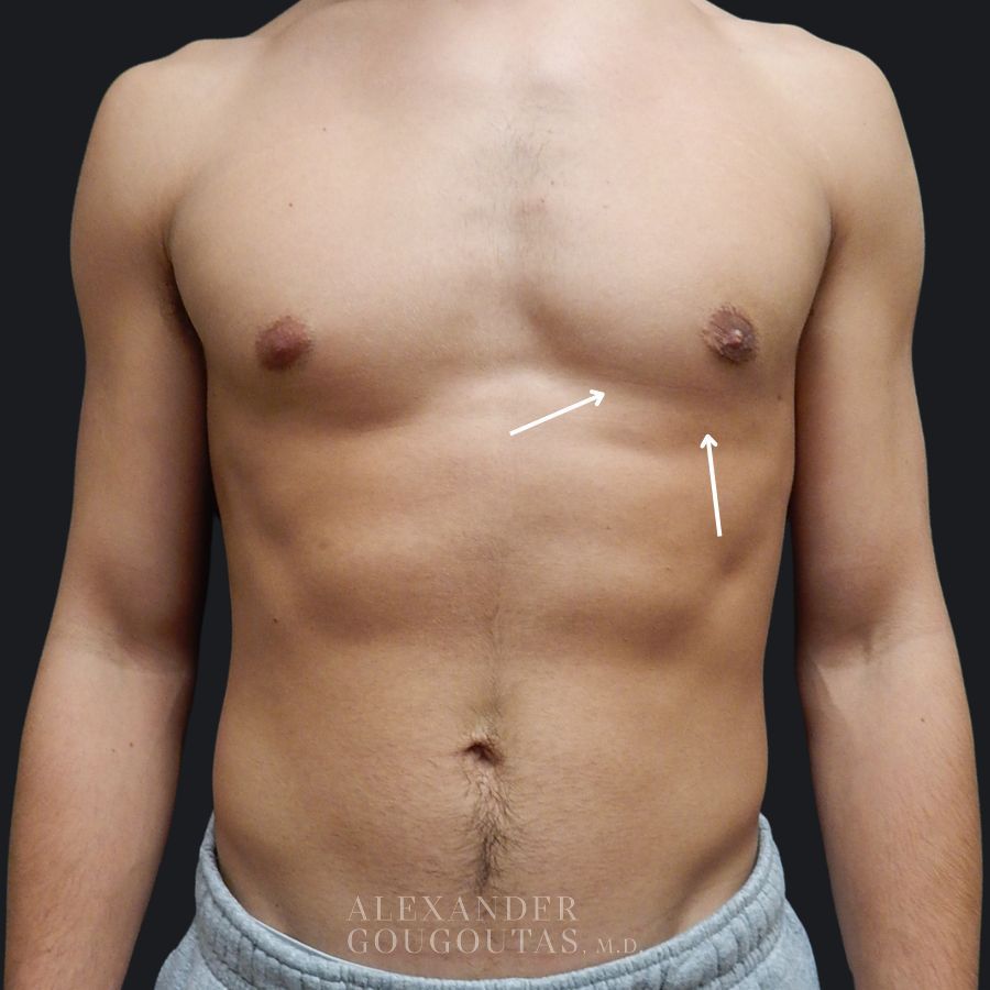 Case--7692 | After Breast Reduction for Men (Gynecomastia) 1
